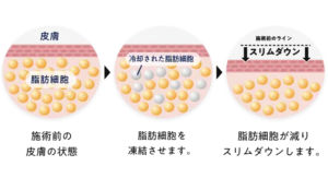 脂肪冷却の仕組み